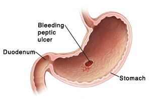 Cross section of stomach and duodenum showing bleeding peptic ulcer.