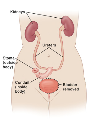 Front view of female torso showing bladder removed with kidneys connected to conduit and stoma by ureters.