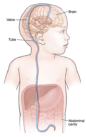 Front view of baby showing VP shunt in brain.