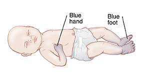 Baby with blue hands and feet.