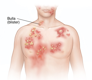 Front view of man's head and chest showing bullous pemphigoid.