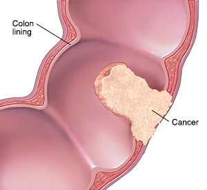 Cross section of segment of colon showing cancer.