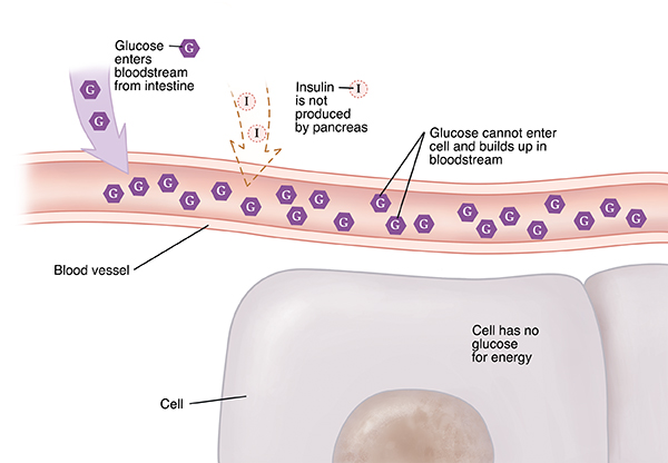 Closeup cross section of blood vessel near cells showing type 1 diabetes. Insulin not produced. Glucose can't enter cell and builds up in bloodstream. Cell has no glucose for energy.