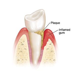 Tooth in bone showing plaque and inflamed gum. 