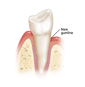 View of tooth in bone with gum lower on right side.