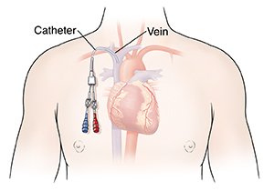 Outline of person's chest showing heart with central line in place.