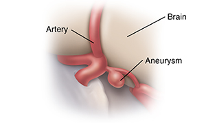 Closeup view of aneurysm in artery to brain..