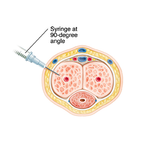 Cross section of soft penis with syringe at 90-degree angle demonstrating penile self-injection.