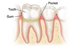 Teeth in gums showing a pocket of gingivitis.