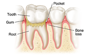 Teeth in gums showing a pocket and bone loss of periodontitis.