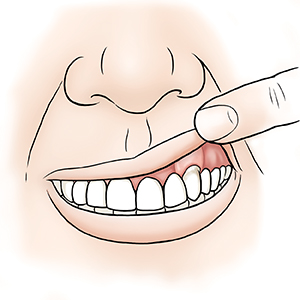 Mouth showing gum with periodontal disease with gum pulled away and view with gum evened out with graft.