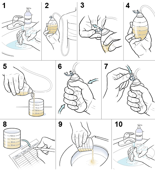 10 steps for how to empty drain after surgery.