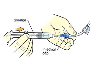 Gloved hands using syringe to inject flushing solution into catheter injection cap.