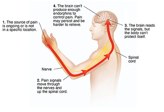 Pain cycle including pain source, nerve signals, spinal cord, and brain not producing enough endorphins.