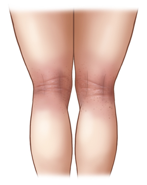 Back view of light-skinned legs showing eczema in the creases behind the knees. 