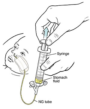 Hand pulling up on syringe attached to child's NG feeding tube with fluid filling syringe.