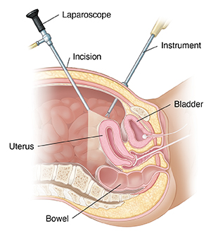 Cross section of female pelvic area showing laparoscopy.