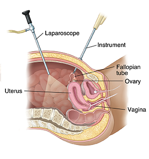 Pelvic area sideview showing laparoscopy to block fallopian tubes.