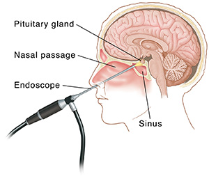 Side view of head and brain showing scope passing through the nose and sinuses and shining light on the pituitary gland.