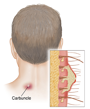 Back view of light-skinned man's head and neck with carbuncle on neck. Inset shows cross section of carbuncle.