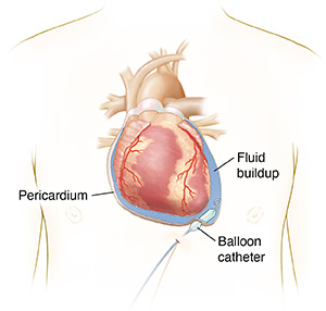 Outline of person's chest showing heart and balloon catheter being inflated in pericardium to drain fluid buildup.