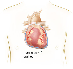 Outline of person's chest showing extra fluid drained from pericardium.