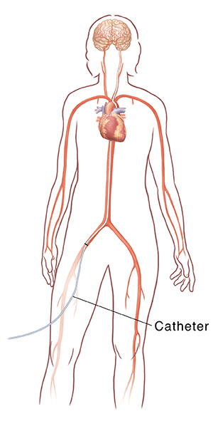 Front view of female outline showing heart, major arteries and brain. Catheter inserted in iliac artery going to brain.