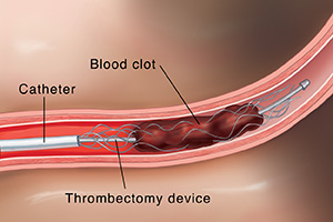 Cross section of artery in brain showing catheter and device inserted into thrombus.