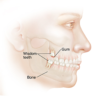 Side view of adult's face showing wisdom teeth in upper and lower jaw.