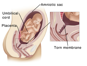 Cross section of pelvis during pregnancy showing baby in amniotic sac in uterus. Inset shows tear in amniotic sac.