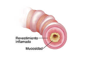 Una vía respiratoria inflamada obstruye (bloquea) el flujo de aire.