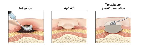 Corte transversal de la piel que muestra tres úlceras por presión. Una se está tratando con irrigación, otra con una venda húmeda y la tercera con presión negativa tópica.