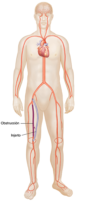 Vista frontal de figura masculina que muestran una derivación poplítea femoral.