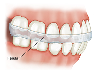 Vista lateral de dientes con férulas.