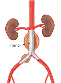 Vista frontal de la aorta abdominal con aneurisma en la que se ve el injerto colocado.